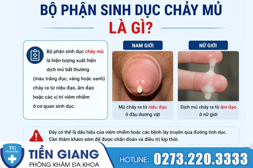 Bộ phận sinh dục chảy mủ là dấu hiệu cần đặc biệt lưu ý.